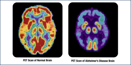 Confronto cervello normale e Alzheimer - PET SCAN encefalo